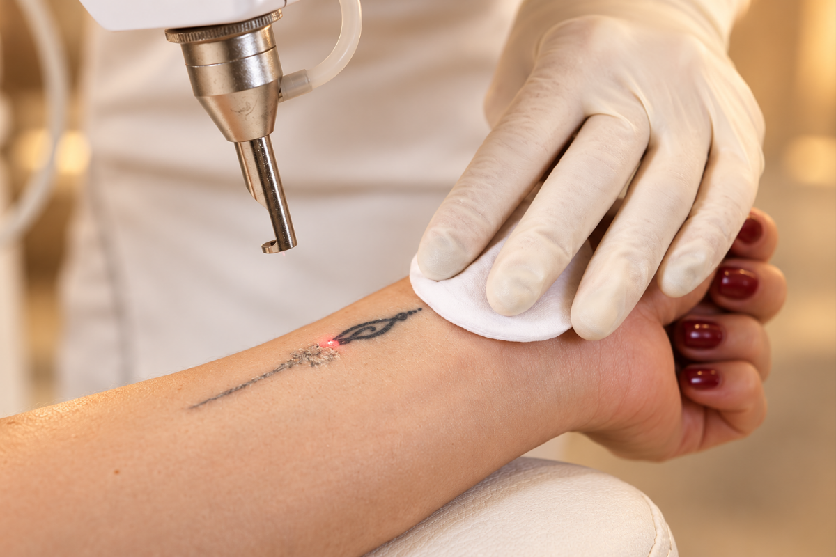 Laser tattoo removal treatment